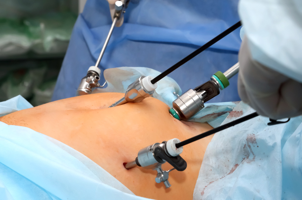 Understanding Laparoscopic Hysterectomy: A Modern Approach to Women's Health