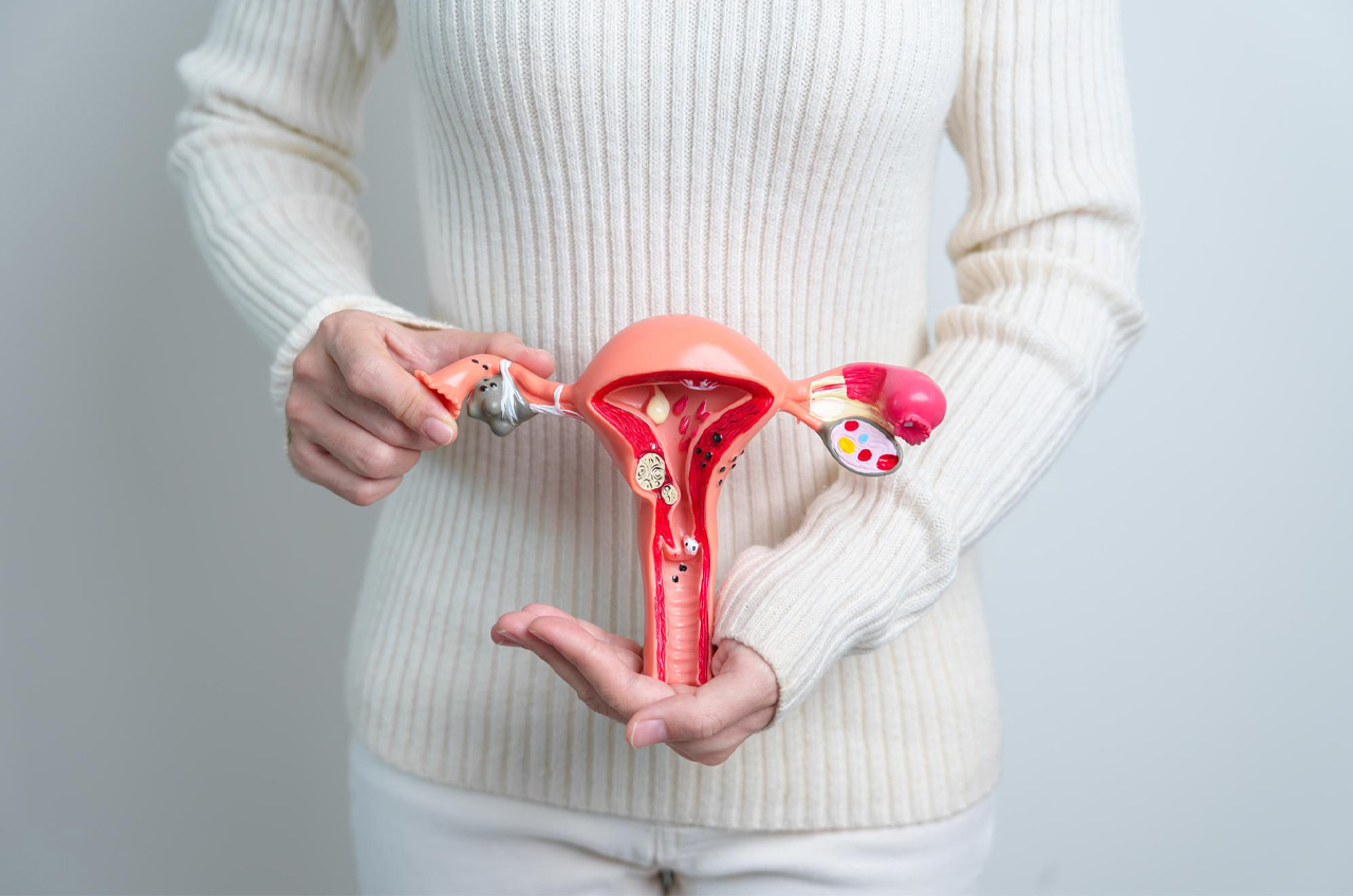 Ovarian Cysts: Understanding, Managing, and Preventing a Common Gynecological Condition