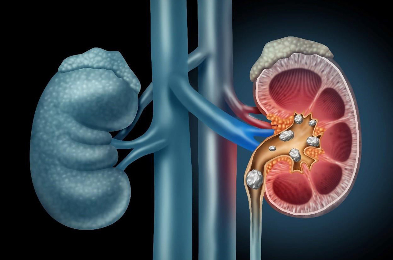 Managing Kidney Stones: Symptoms, Treatment, and Prevention